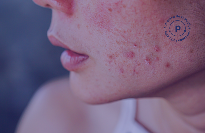 Ansiedade e depressão podem causar surtos de acne: vem da conexão mente e pele?