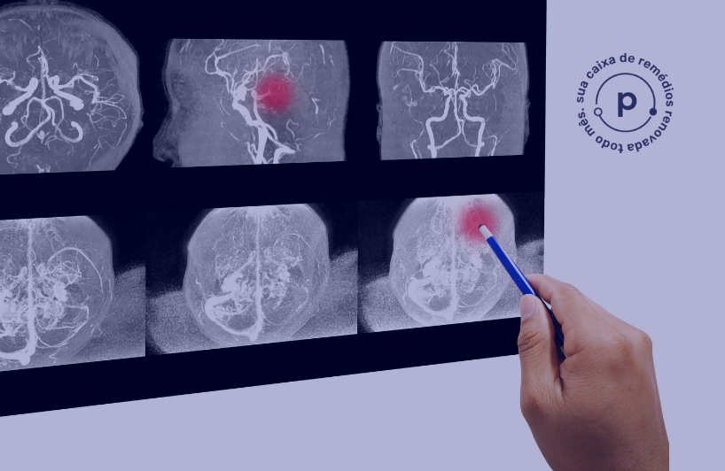 Aneurisma: Compreendendo a Condição, Sintomas e Tratamentos