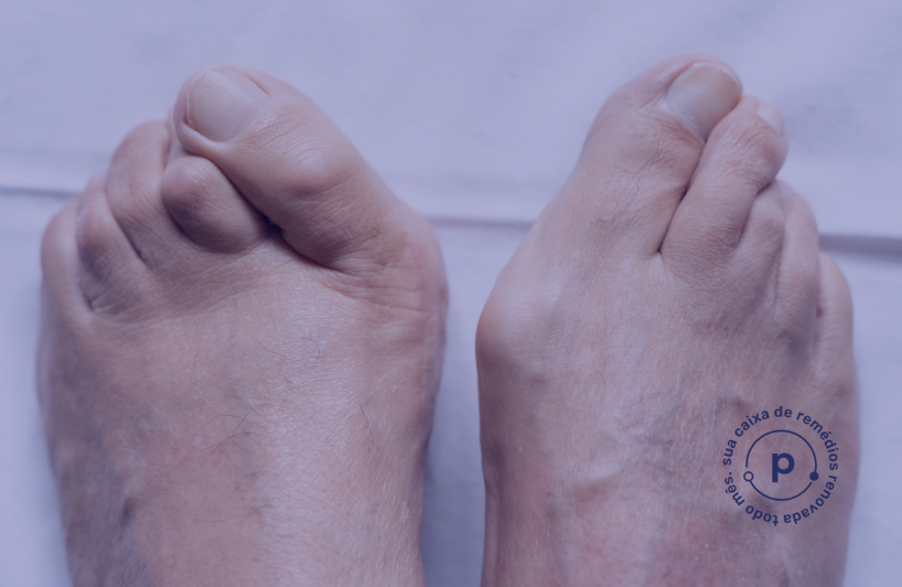 Complicações nos Pés do Diabético: o que é dedo em martelo e como o podólogo pode ajudar