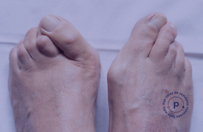 Complicações nos Pés do Diabético: o que é dedo em martelo e como o podólogo pode ajudar